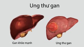 Mỗi năm có khoảng 25.000 ca tử vong do ung thư gan