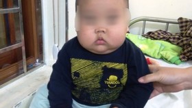 Uống thuốc có Corticoid, bé trai 17 tháng tuổi tăng 3 kg nhưng bị suy thận cấp!