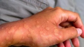 Tư vấn các bệnh về da liễu cho chiến sĩ hải quân