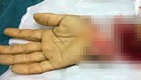 Truy xét nhóm đòi nợ chém gần đứt lìa tay người đàn ông ở TPHCM