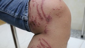 A man is attacked by rove beetle in the leg (Photo: SGGP)