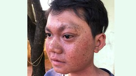Từ bài viết “Xin cứu đôi mắt em”: Đưa em Liên đi phẫu thuật