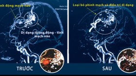 Ảnh chụp CT trước và sau khi phẫu thuật