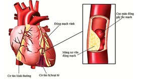 Những biểu hiện bệnh động mạch vành