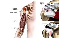Các tổn thương thường thấy ở khớp vai: Viêm gân cơ nhị đầu; viêm hoặc rách cơ chóp xoay; viêm bao hoạt dịch khớp vai (thường co thắt gây cứng khớp vai).