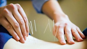 Châm cứu phục hồi vận động sau đột quỵ não