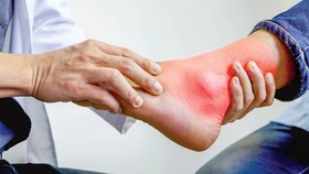 Không chủ quan điều trị bệnh gout