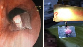 Nội soi gắp viên thuốc còn nguyên vỏ nằm ở thực quản