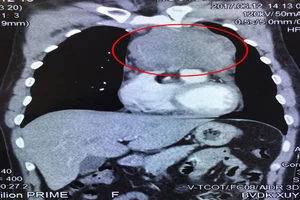Ảnh chụp CT khối u (khoanh đỏ) trong lồng ngực bệnh nhân trước phẫu thuật 