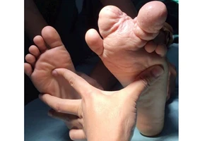 Bàn chân dị tật với 2 ngón chân khổng lồ trước phẫu thuật