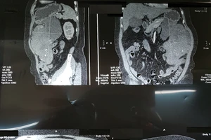 Hình chụp cắt lớp khối u của bệnh nhân N.T.L.