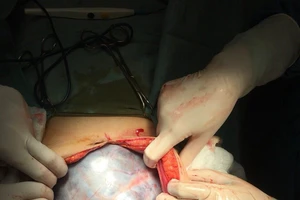 Hình ảnh khối u trong bụng bệnh nhân
