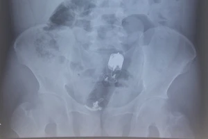 Hình chụp X quang dị vật nằm sâu bên trong trực tràng bệnh nhân