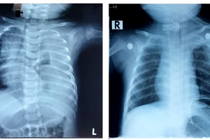 Phim chụp Xquang trước phẫu thuật của bệnh nhi phổi bên trái có nhiều dịch trắng xóa và phim chụp Xquang sau phẫu thuật