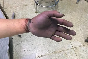 Vùng bàn tay và ngón tay của bệnh nhân tím, thiếu máu nuôi toàn bộ
