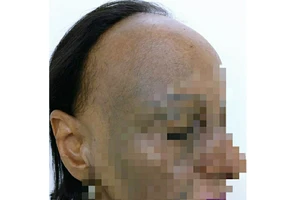 Bệnh nhân mắc bệnh lý về da và tóc hiếm gặp