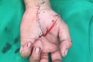 Nối bàn tay bị đứt lìa ngay trong đêm cho bệnh nhân