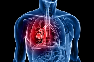 Chụp CT phổi liều thấp để sàng lọc và phát hiện sớm ung thư phổi