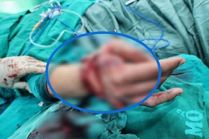 Bác sĩ đang thăm khám cho bệnh nhân sau phẫu thuật vi phẫu nối bàn tay đứt lìa