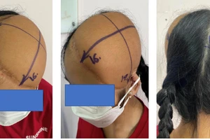 Hình ảnh tóc bệnh nhân mọc qua các quá trình điều trị