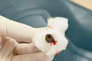 Nội soi gắp viên pin điện tử ra khỏi mũi bệnh nhi 2 tuổi