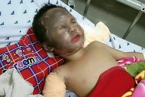 Nghịch xăng, bé trai 4 tuổi bị phỏng nặng