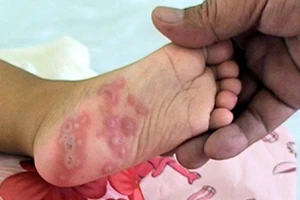Bình Định: Bệnh tay chân miệng ở trẻ em tăng cao