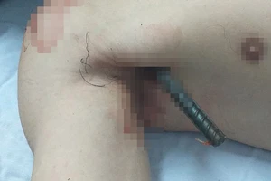 Phẫu thuật cứu thanh niên bị 2 thanh sắt đâm xuyên qua người