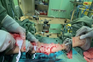 Bệnh viện Bà Rịa: Mổ cấp cứu 1 bệnh nhân bị chó cắn đa vết thương