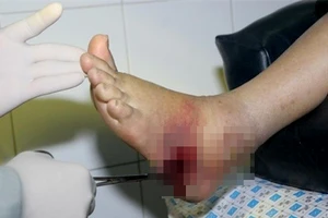 Phẫu thuật kịp thời chân bị nhiễm trùng nặng 