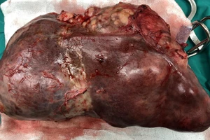 Phẫu thuật cắt thành công khối u lá lách gần 3kg