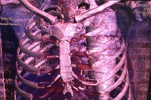 Chụp CT scaner, các bác sĩ phát hiện vỏ chai nước khoáng trong lồng ngực bệnh nhân