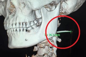Vị trí xương cá nằm trong cổ họng bệnh nhân suốt 3 tháng. Ảnh chụp CT cổ bệnh nhân