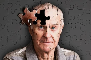 Dự án phát hiện sớm bệnh Alzheimer