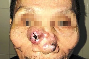 Khối u lớn trên mũi gây biến dạng khuôn mặt của bệnh nhân Q.