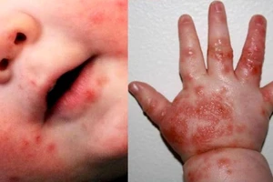 Trẻ bị tay chân miệng do virus EV71 gây ra có nguy cơ bị viêm não