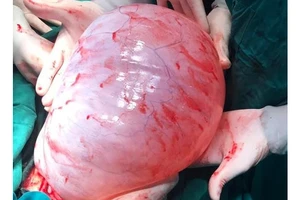 Thiếu nữ 22 tuổi “đốt ngải” để trị khối u buồng trứng gần 8 kg