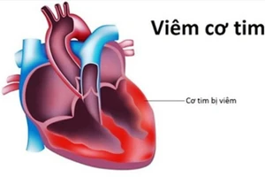Viêm cơ tim có thể do nhiều loại virus, vi khuẩn gây ra
