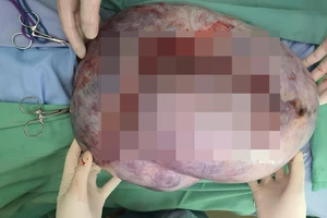 Cô gái 30 tuổi mang khối u buồng trứng hơn 13kg được phẫu thuật thành công