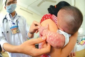 Dịch sởi tăng cao tới 42 lần, tiêm bù, tiêm vét ngay vaccine cho trẻ