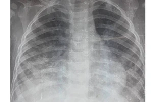  Hình ảnh tổn thương phổi của bệnh nhi D. thể hiện trên phim chụp XQ