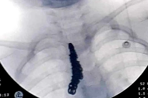 Gắp sợi dây chuyền bạc dài 14cm trong khí phế quản của bệnh nhi 28 tháng tuổi
