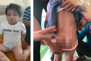 Hà Tĩnh: Một bé gái nhập viện nghi bị đánh