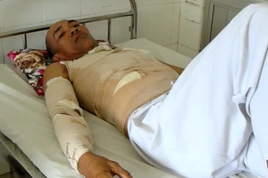 Một nạn nhân bị bỏng đang được điều trị tại Bệnh viện Trung ương Cần Thơ