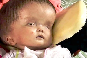 Góp sức cứu cháu bé 5 tháng tuổi bị não úng thủy