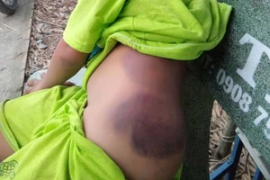 Em K, học sinh lớp 1 Trường Tiểu học Bình Hữu bị đánh bầm tím ở phần hông. Nguồn: DANTRI.COM.VN