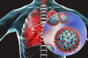 SARS-CoV-2 phá hủy đáng kể hệ thống miễn dịch của bệnh nhân ung thư chưa tiêm phòng