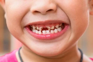 Hơn 85% trẻ 6-8 tuổi gặp các bệnh về răng miệng