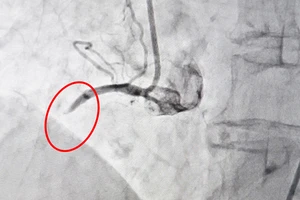 Ảnh DSA - động mạch vành phải của bệnh nhân bị tắc nghẽn hoàn toàn trước khi can thiệp