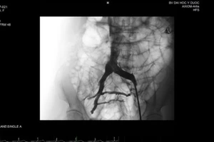 Hình ảnh stent đặt trong lòng tĩnh mạch